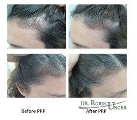 Before & After PRP