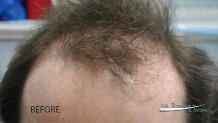 Hair Transplant in 49 Year Old Male to the front and vertex