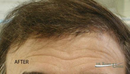 Correcting “pluggy looking” hair transplant