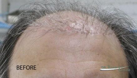 Correcting “pluggy looking” hair transplant