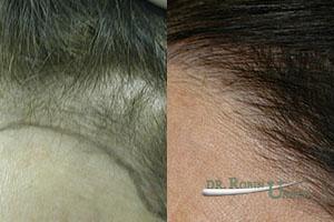Before-female-hair-transplant-and-results-after-surgery