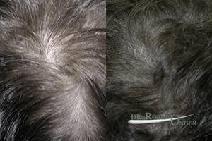 Treatment to hair thinning in the vertex
