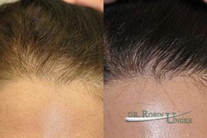 Before-hair-transplant-surgery-and-results