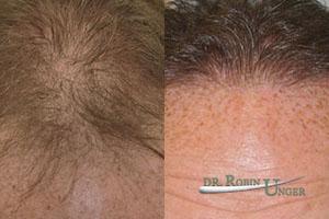 Before-hair-transplant-to-the-front-and-ten-months-after-surgery