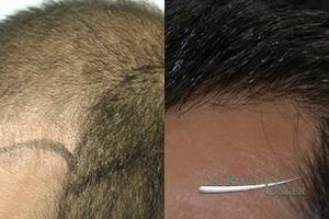 Before-midscalp-hair-transplant.-One-year-later