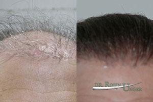 Before-repair-surgery-three-years-after-3rd-surgery