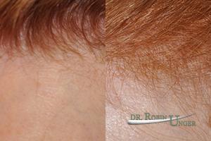Before-surgery-to-frontal-area-and-results-after-one-year