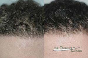 Before-surgery.-11-months-after-surgery-to-entire-frontal-area-without-a-hyper-dense-hairline