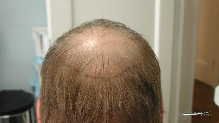 Male Hair Transplant Surgery to Crown Before & 5 Years After