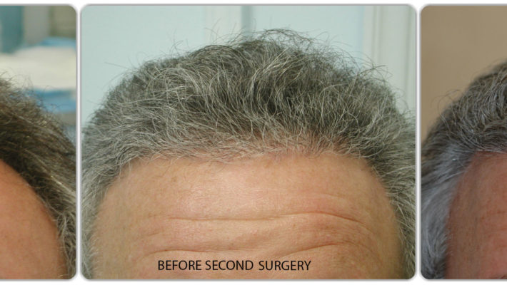 Hair transplant in pre-existing hair