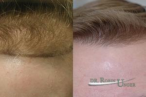 Male Hair Transplant Before and 2 Years After With Some Loss of Original Hair