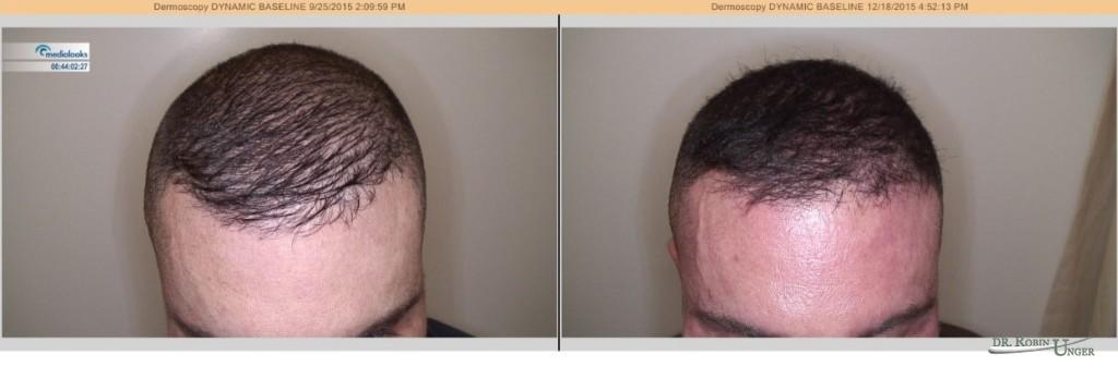Male Pattern Hair Loss