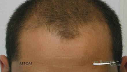 Hair transplant to the entire frontal region