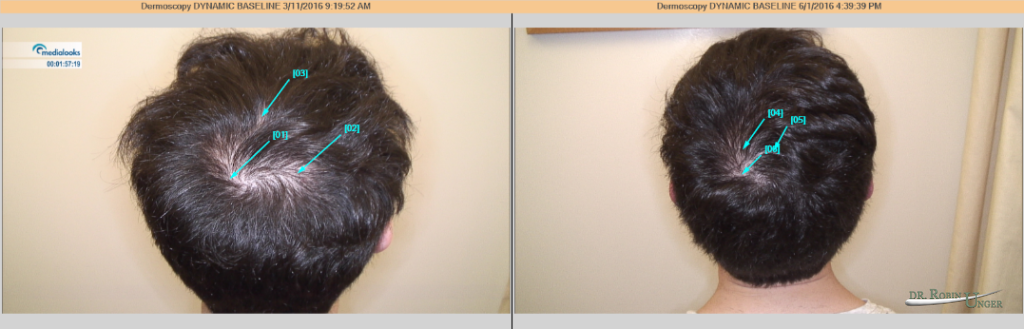 PRP for early Hair Loss