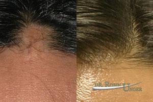 Hair transplant to correct scars