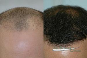 Young-man-with-fairly-advanced-MPB-after-one-surgery-to-the-frontal-half-including-future-areas-of-loss