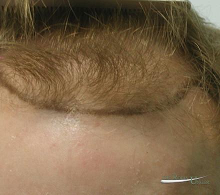 Male Hair Transplant Before and 2 Years After With Some Loss of Original Hair