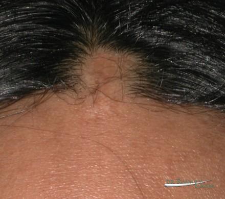 Hair transplant to correct scars