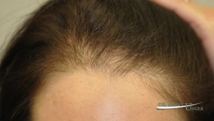 Young woman with hairloss, on spirinolactone and rogaine