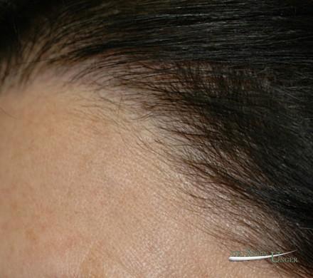 Women’s hair replacement surgery