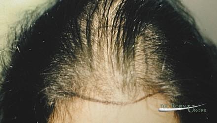 Hair transplant to area of female hair loss