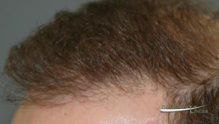 Men’s hair transplant surgery correction