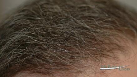 Subtle hair transplant surgery for men