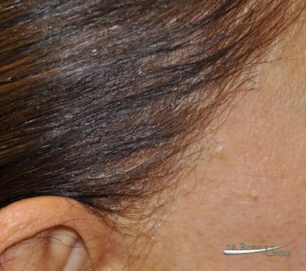 Hair transplant surgery to correct facelift scar