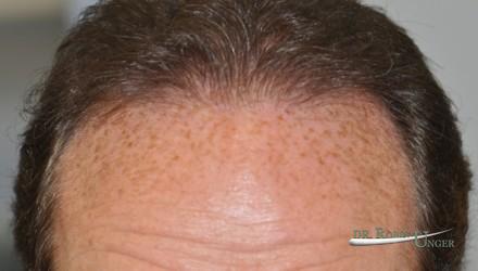 Hair transplant surgery for male hair loss