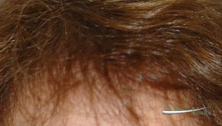 Women’s hair transplant and correction of scar