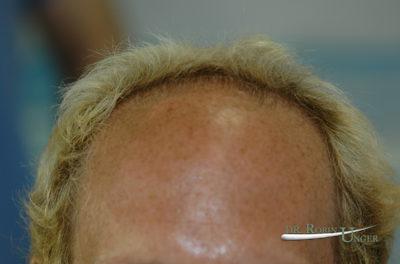 Hair Transplant in 45 Year Old Male