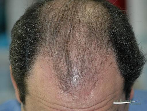 Treatment of a very large bald area