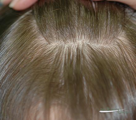 Young woman with PCOS and hair loss