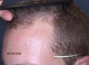 After PRP Treatment Hair Loss Doctor NYC