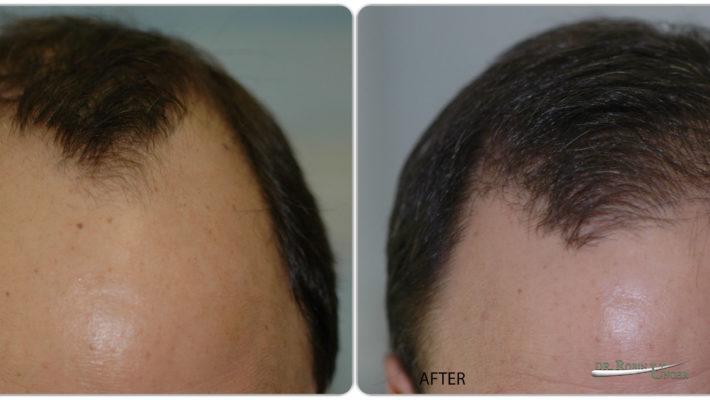 61 Year Old Male With Previously Transplanted Hair By Another Doctor
