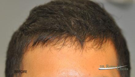 Hair transplant to the front