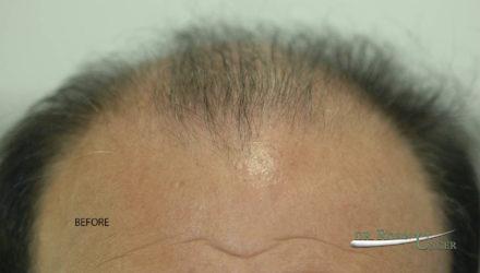 Correction of old hair transplant surgery