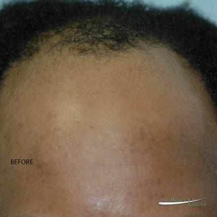 Hair Transplant in 34 Year Old Male