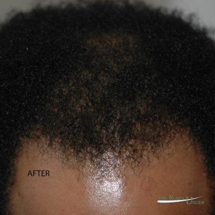 Hair Transplant in 34 Year Old Male