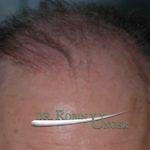 Male Hair Transplant To Front