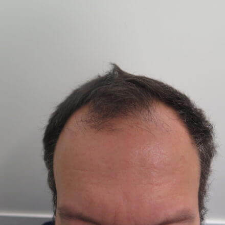 Hair Transplant in 52 Year Old Male