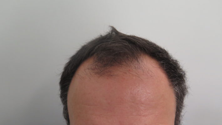 Hair Transplant in 52 Year Old Male
