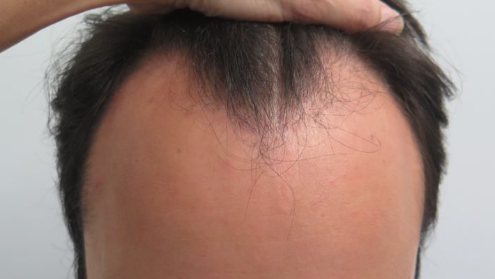 Hair Transplant in 23 Year Old Male